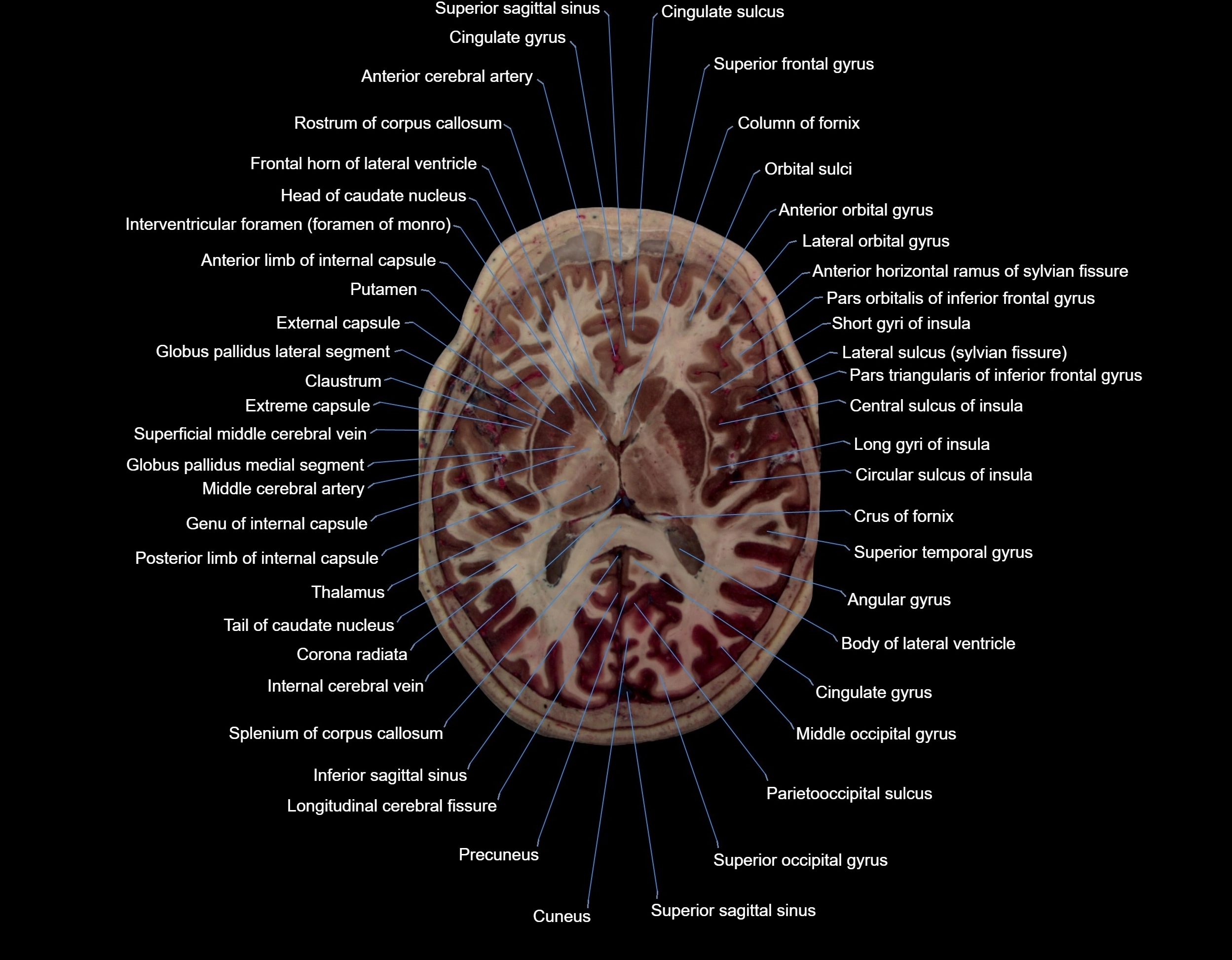 MRI Brain axial cross sectional radiology anatomy 3T image  -img-000044.webp